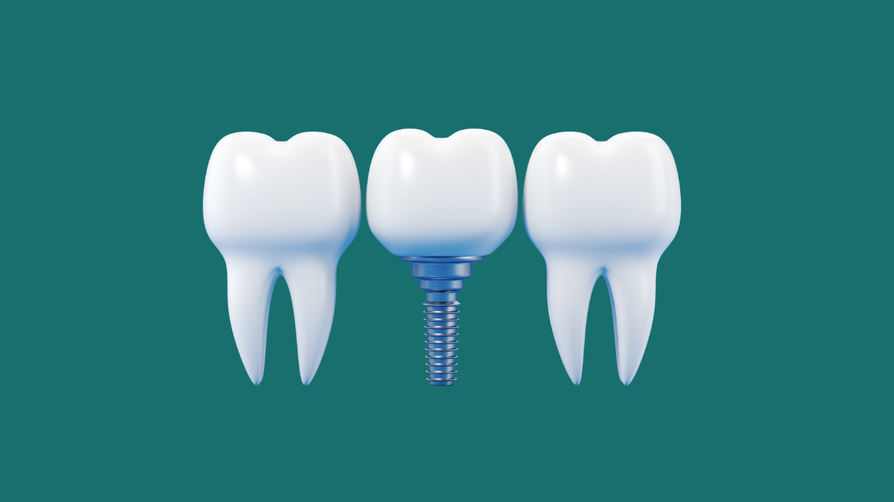 Dental Implant Services Near Me In